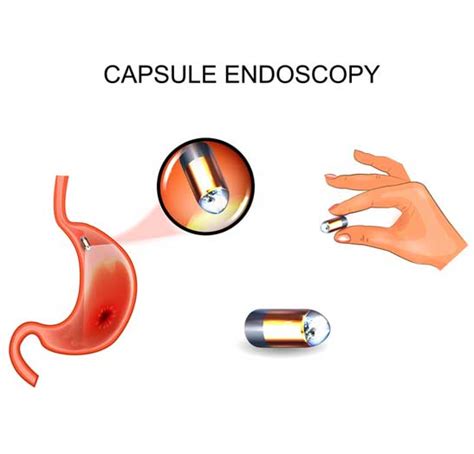 Capsule Endoscopy Procedure Cape Town | Dr Jacques Badenhorst