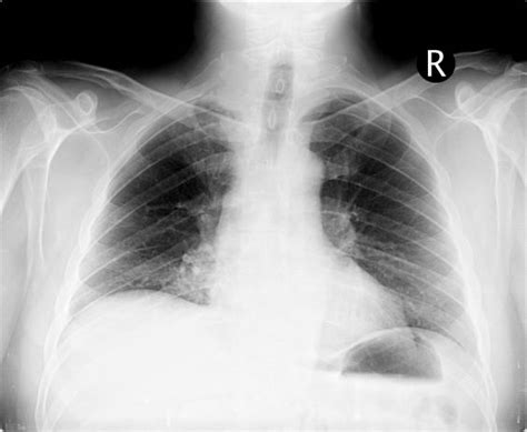 Shoulder pain and forearm paresthesias | Lung Cancer Challenge Center