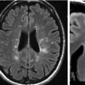 MS gray and white matter lesions in the brain shown by MRI imaging [8]. | Download Scientific ...