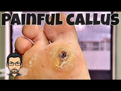 CALLUS REMOVAL FROM FEET - YouTube