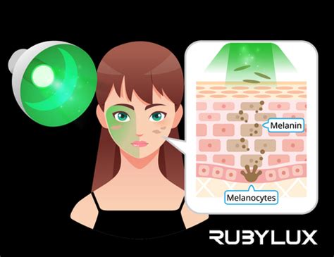 Green Light Therapy for Hyperpigmentation and Age Spots – RubyLuxLights