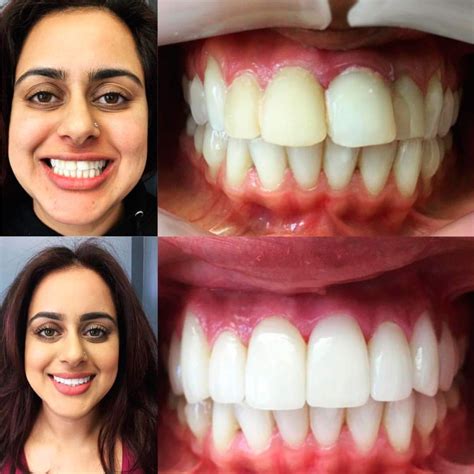 Cosmetic Veneers – NORCAL DENTAL GROUP