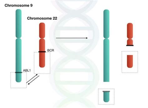 Philadelphia chromosome: reciprocal translocation between chromosome 9 and 22. | Chromosome ...