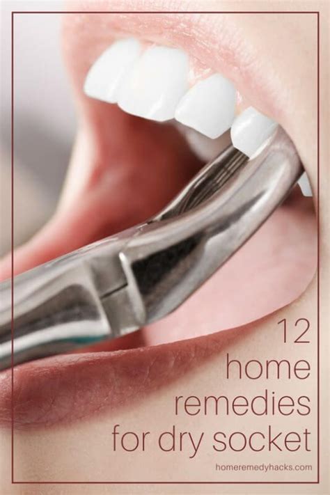 12 Home Remedies to Get Rid of Dry Socket | Dry socket, Dry socket remedies, Home remedies