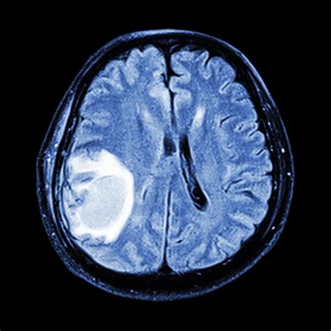 MRI brain : show brain tumor at right parietal lobe of cerebrum — Stock Photo © stockdevil_666 ...