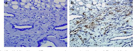 Figure 4 from Hepatic Kaposi's sarcoma in a patient affected by AIDS ...