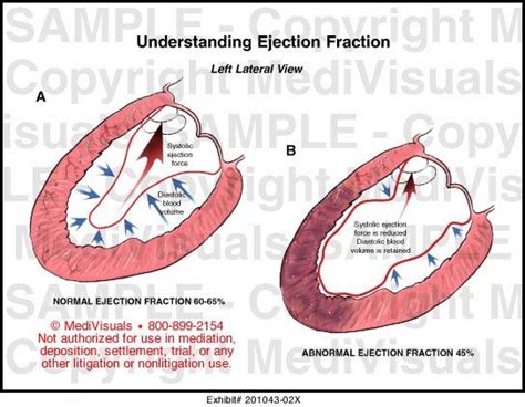 Understanding Ejection Fraction Medical Exhibit Medivisuals | Understanding, School tool, Fractions