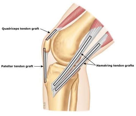 ACL Reconstruction: Graft Choices: Colorado Sports Medicine & Orthopaedics: Orthopaedics