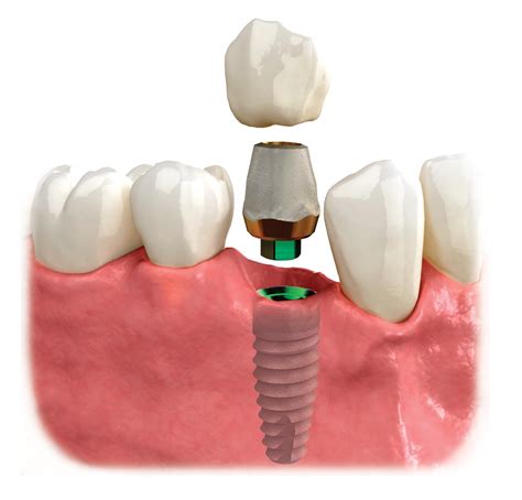 Dental Implants in Tampa, FL | Weninger Dentistry