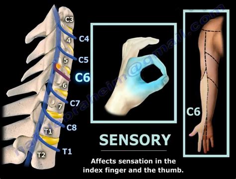 Neck Pain Cervical Disc Herniation And Radiculopathy | Images and ...