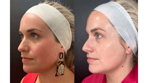 Gentle Skin Renewal with Moxi™ Laser Skin Rejuvenation - Poris Plastic Surgery - Orlando, FL