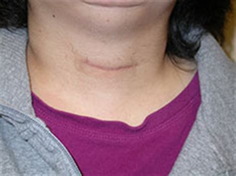 Thyroid Surgery. Alexander Shifrin, MD | www.Thyroid-Center.org