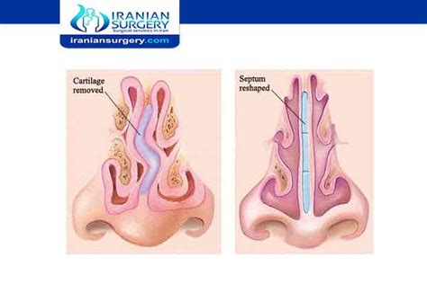 septoplasty complications | avoidance and management | Iranian Surgery