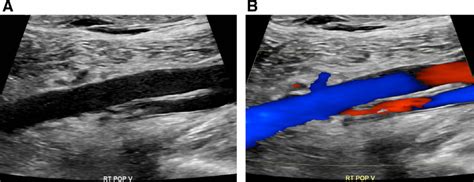 -(A) Ultrasound image of the right popliteal vein demonstrates a patent... | Download Scientific ...