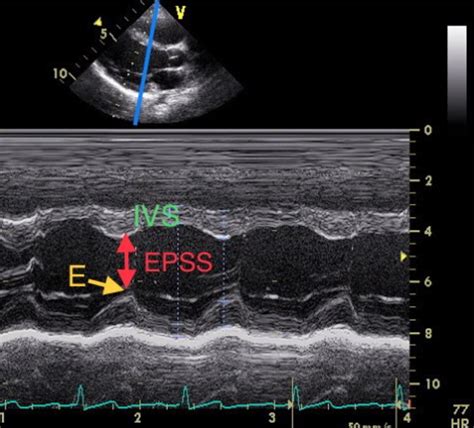 Using POCUS for Ejection Fraction Estimation — BROWN EMERGENCY MEDICINE BLOG