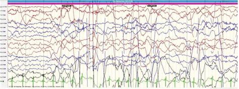 The pattern of this epileptic spasm is difficult to identify on the... | Download Scientific Diagram