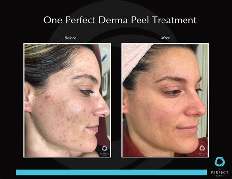 The Perfect Derma Peel Orlando