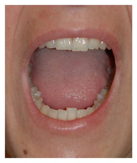 A 39-year-old woman with microstomia before treatment. | Download Scientific Diagram