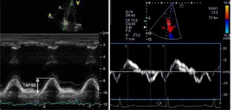 Measurement of TAPSE (Left) and pulsed wave TDI of the lateral ...