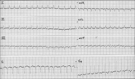 Tachycardia, Ectopic Atrial; Atrial Ectopic Tachycardia; Ectopic Atrial Tachycardia