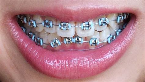 Coastal Orthodontic Care, Dr. Adam G. Lautt, 805-650-1080 | Dental braces, Braces teeth colors ...