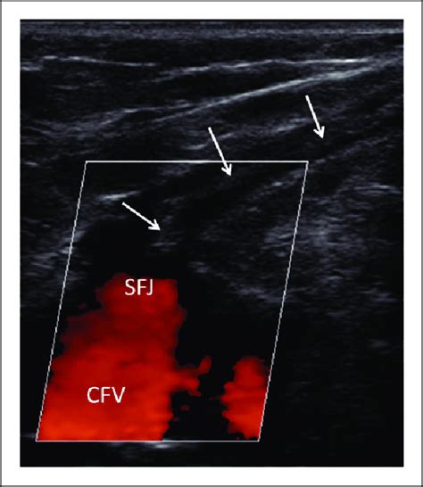 Ultrasonographic image of the saphenofemoral junction (SFJ) and the ...