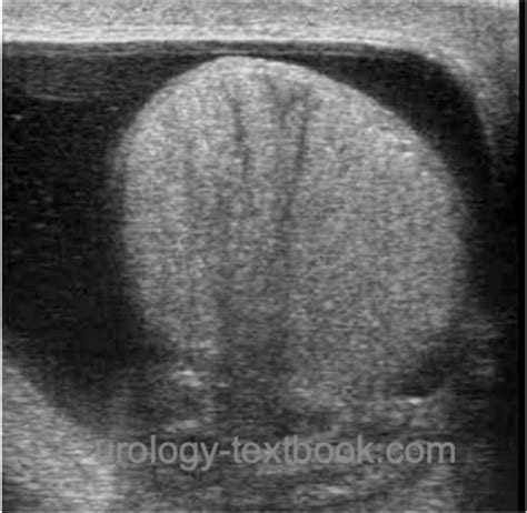 Hydrocele testis: Causes, Diagnosis and Treatment