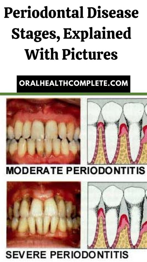 Periodontal Disease Stages