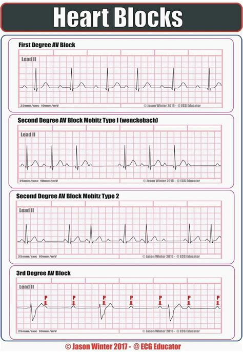 Ekg Practice Strips Printable