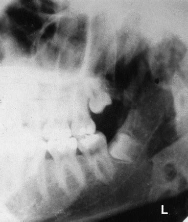 12: Oblique lateral radiography | Pocket Dentistry