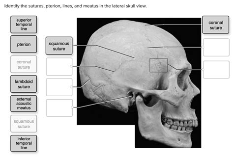 SOLVED: Identify the sutures, pterion, lines, and meatus in the lateral skull view. - Superior ...