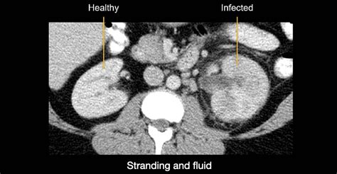 Abdominal CT: renal infections • LITFL • Radiology Library