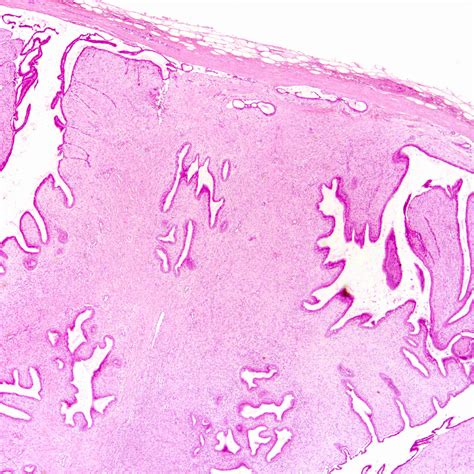 Pathology Outlines - Phyllodes tumor