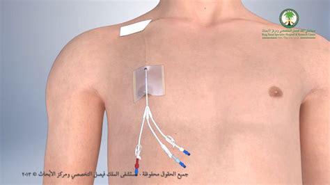 Hickman Line Insertion Procedure on Vimeo