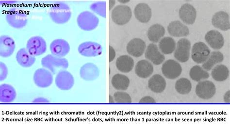 Plasmodium Falciparum Ring Stage