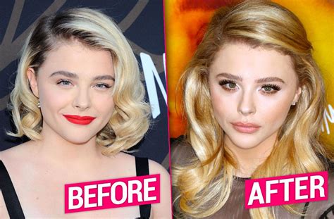 Chloë Grace Moretz Plastic Surgery Speculation Nose Job & Lip Fillers