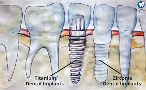 Titanium Vs. Zirconia Tooth Implants: Cost, properties, pros & cons