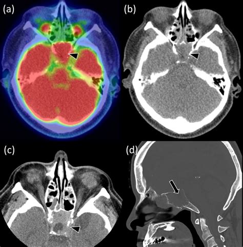 -The mass in the sphenoid sinus on PET-CT and CT. 18F-FDG PET/CT shows ...