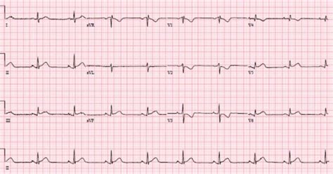 Cardiac syncope ECG Interpretation | ECG cases | EM Cases