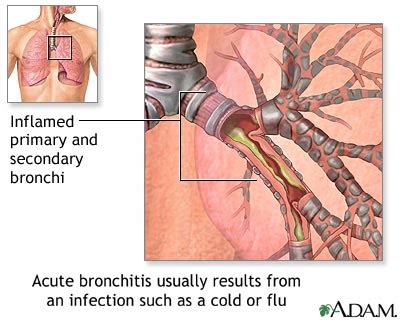 Acute bronchitis: MedlinePlus Medical Encyclopedia