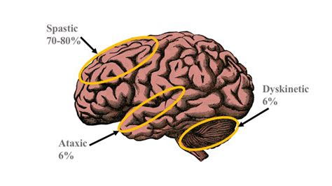 Causes of cerebral palsy | General center | SteadyHealth.com