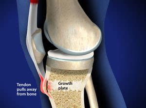 Treating Osgood-Schlatter Disease in Plano, Frisco, McKinney and Allen