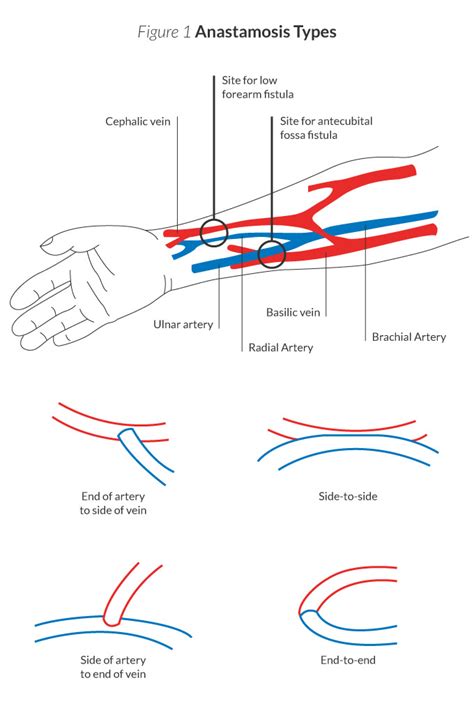 laminate-blog-illus_types-of-anastomosis