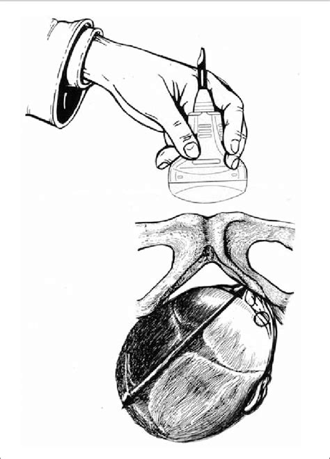 Transversal ultrasonographic section of right occiput posterior... | Download Scientific Diagram