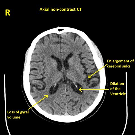 Alzheimer's disease CT scan - wikidoc