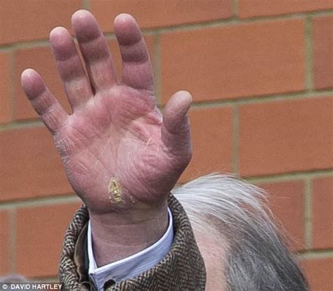 Prince Charles reveals cracked and tired looking hand | Daily Mail Online