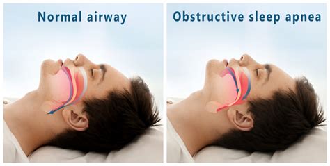 What are My Surgical Options for Sleep Apnea?