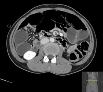 Reversed Bowel Rotation with Midgut Volvulus and Internal Hernia ...