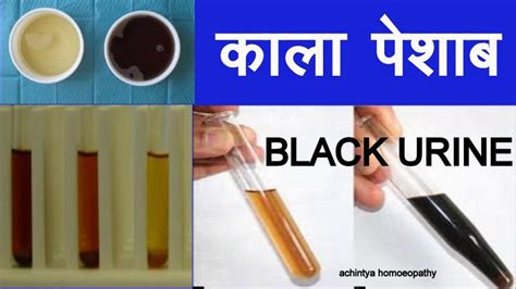 काळा पेशाब (BLACK URINE) - YouTube