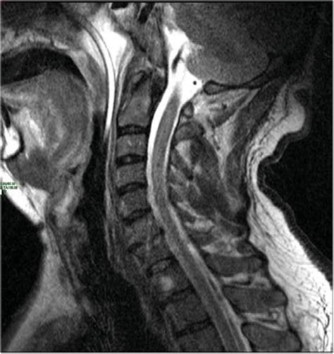 MRI cervical spine revealed no abnormalities in the spinal cord. | Download Scientific Diagram